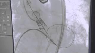 Medical Procedures  Stent Placement