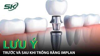 Những Lưu Ý Trước Và Sau Khi Trồng Răng Implant  SKĐS