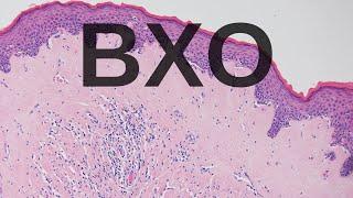 Balanitis Xerotica Obliterans BXO - Pathology mini tutorial