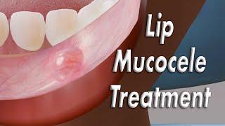 Inner Lip Mucocele Inside Lip Bump Surgical Treatment