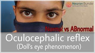 Doll’sEyeReflex Vestibulo Ocular reflex #Normal & #ABnormal #MADE-EASY #medicine #neurology