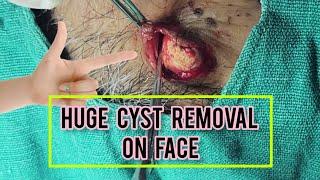 Large cyst removal with comedones blackheads and whiteheads on face  #Dr.AMAZINGSKIN