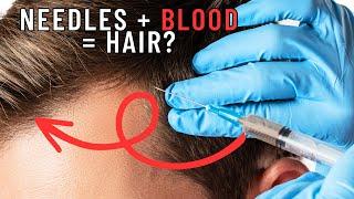 The Good and The Bad of PRP Injections for Hair Loss