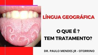 Língua geográfica e fissurada o que é  sintomas e tratamento?