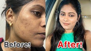 ಕಪ್ಪು ಕಲೆ ಮೊಡವೆ ಕಲೆ hyperpigmentation ಮುಕ್ತ ಕಾಂತಿಯುತ ತ್ವಚೆಗಾಗಿ ಹೀಗೆ ಮಾಡಿ SnehaLoka