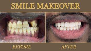 Implant+ Bone graft 10 Days Finishes Everything Dental Implants + Zirconium @GoldenSmileDent