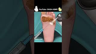 ASMR  Surgery to Remove Large Plantar Warts Animation  Corn Foot Calluse HPV Treatment part2