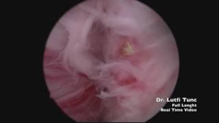 Dr. Lutfi Tunc Holmium Laser Enucleation of Prostate HoLEP 18.06.2016 Case 1