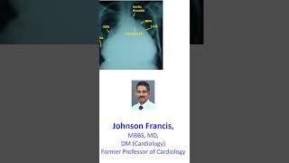 Gross Cardiomegaly on Chest X-Ray PA View