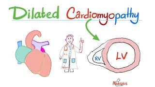 Dilated Congestive Cardiomyopathy Systolic Dysfunction - Causes Symptoms Diagnosis Treatment