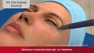 Alt Göz Kapağı Blefaroplasti Ameliyatı Videosu Bursa