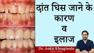 दांत घिस जाने के कारण व इलाज  Dr. Ankit Khasgiwala  Seraphic Dental  Indore