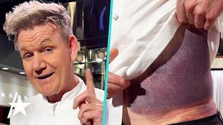 Gordon Ramsay Reveals MASSIVE Bruise After Bike Accident