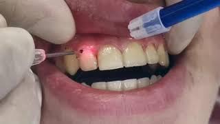 Laser Gingivectomy gum cutting using laser gingival line reshaping after braces removal