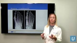 Bunions & Hammertoes  Joan Williams MD  UCLAMDChat