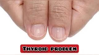 common nail abnormalities and probable causes  health secrets hiding in your nails