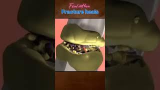 Fracture Healing 3D Animation