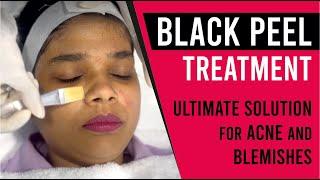 Ultimate Solution for Acne and Blemishes  Black Peel Treatment at Sakhiya Skin Clinic