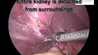 Key hole surgery for kidney cancer treatment