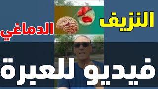 للعبرة، النزيف الدماغي