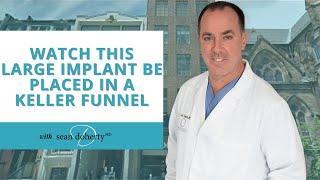 Watch This Large Implant Be Placed In A Keller Funnel