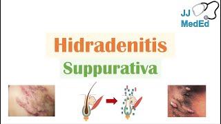 Hidradenitis Suppurativa HS  Pathophysiology Triggers Signs & Symptoms Diagnosis Treatment