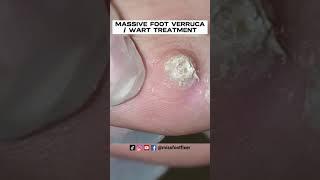 PATIENT MIGHT USING **BAZUKA** MASSIVE FOOT VERRUCA  WART TREATMENT BY PODIATRIST MISS FOOT FIXER