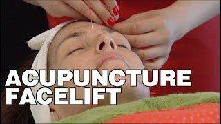 Rebecca Spera explains how acupuncture can get rid of wrinkles