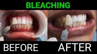 Teeth Bleaching - दाँतों को सफेद करें सिर्फ 10 मिनट में  Cost of Teeth whitening Treatment ?