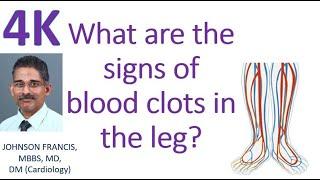 What are the signs of blood clots in the leg?