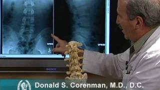 How to Read X-rays of the Lumbar Spine Lower Back  Spine Surgeon Colorado