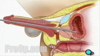 Cystoscopy Male via Penis Surgery - Patient Education