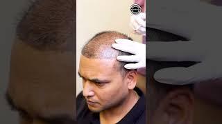 PRP Treatment for Hairloss  Hair Transplant Clinic   Dadu Medical Centre