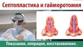 Септопластика - исправление перегородки носа. Показания операция восстановление. Гайморотомия