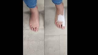 A Simple Technique For Taping Children With Bunions