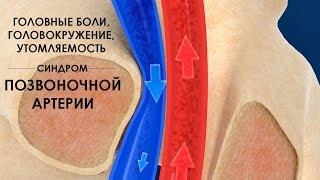 Головные боли головокружение утомляемость - синдром позвоночной артерии