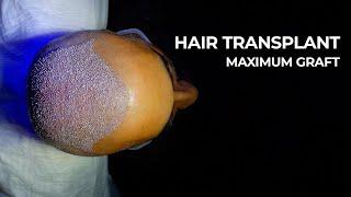 Sapphire Fue Hair Transplant - All Process