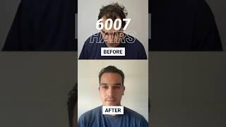 2200 Grafts FUE Method  Hair Transplant Result #shorts #hairtransplantbeforeafter