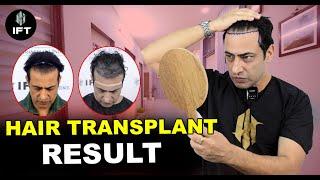 Celebrity Aryan Harnot Hair Transplant Stunning Before & After in Jaipur  Cost & Details