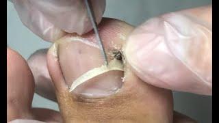 Dig out thick nail inside corner nail pressure relief skill