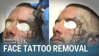 Watch This Man Have His Face Tattoo Removed From Laser Surgery  Business Insider