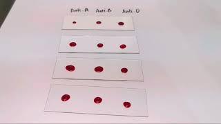 Blood typingRh positive slide agglutination test MEDICAL LABORATORY SCIENCE