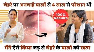 Facial Hair को किया बिना Laser के ठीक  Patient *Review* Hirsutism Ayurvedic Treatment 100% Results