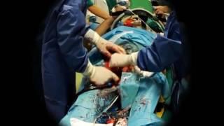 ECPR Extracorporeal CardioPulmonary Resuscitation