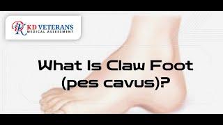 What Is Claw Foot Pes Cavus  Pes Cavus VA Rating  K&D Veterans Medical Assessment