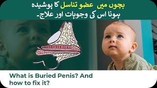 What is Burried or Hidden penis in children?  Its Reason and treatment  Hindi and Urdu