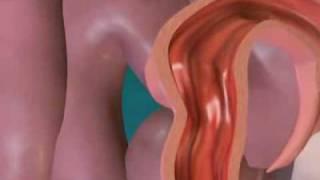 ECTOPIC PREGNANCY.avi