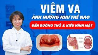 Viêm VA Ảnh Hưởng Như Thế Nào Đến Đường Thở  & Kiểu Hình Mặt ?  Nam Bùi Vinalign