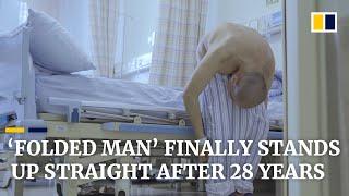 ‘Folded man’ stands up straight after 28 years following surgery that broke bones