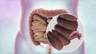 What is bowel cancer?  Cancer Research UK